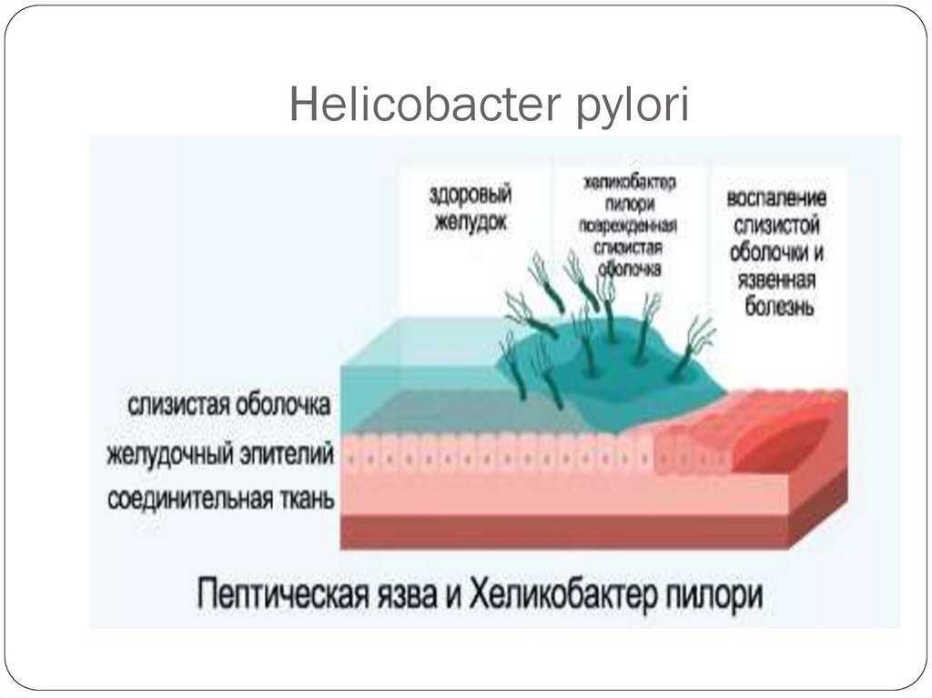 Helicobacter pylori y sibo es lo mismo