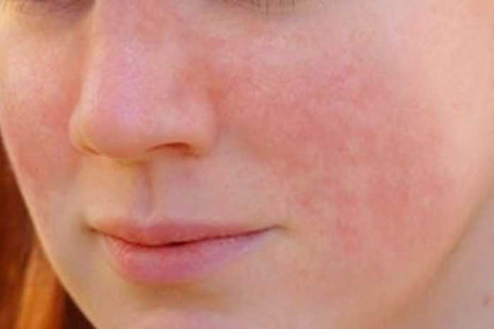 Психологические особенности заболеваний кожи