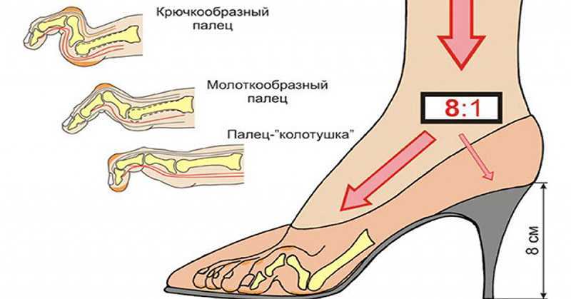 Какой вред несут высокие каблуки? рекомендации по снижению вреда от каблуков.