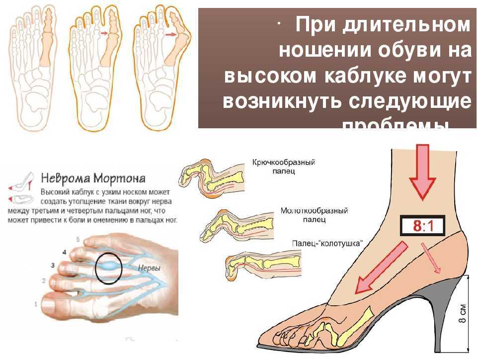 Негативное влияние на здоровье обуви на каблуке Что происходит в организме, связанные с ношением каблуков заболевания, кому противопоказана обувь на каблуках