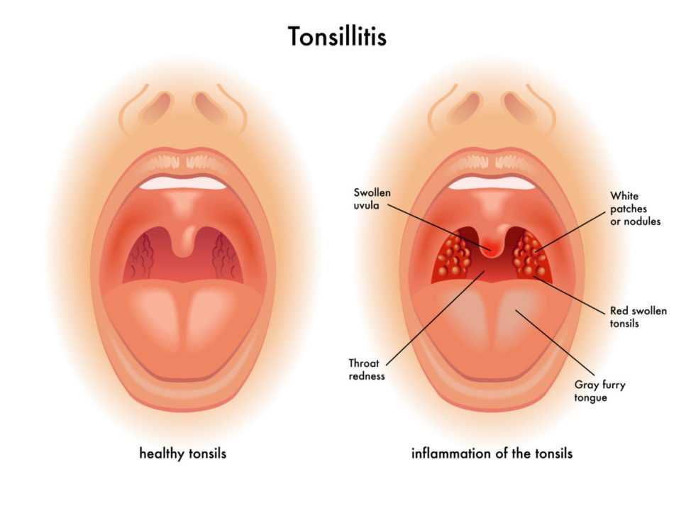 Тонзиллит: симптомы, лечение у детей, взрослых, беременных
